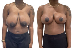 Before-After-Breast-Reduction-1019-9.jpg